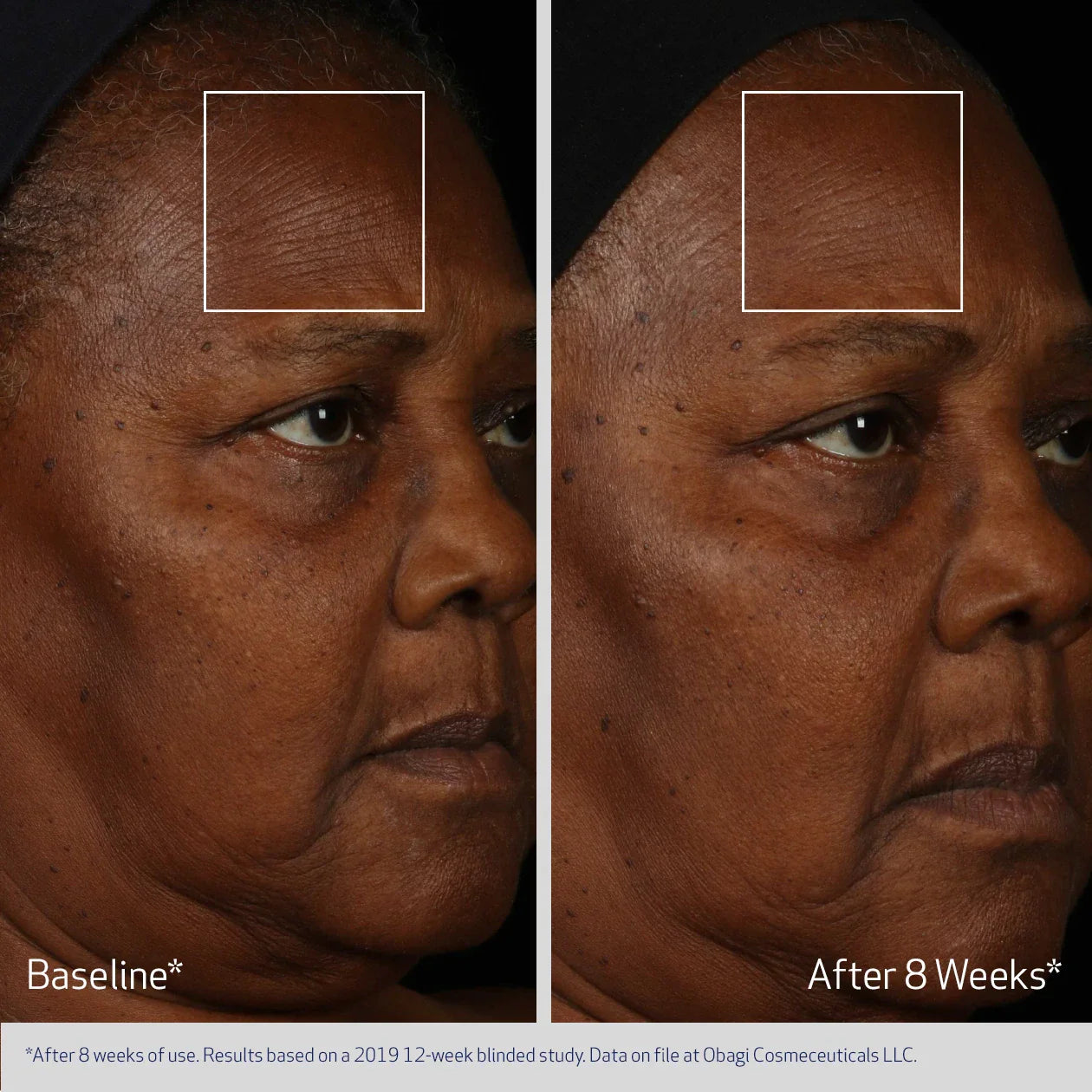 Before and after comparison of a person's face with visible skin texture changes over 8 weeks.