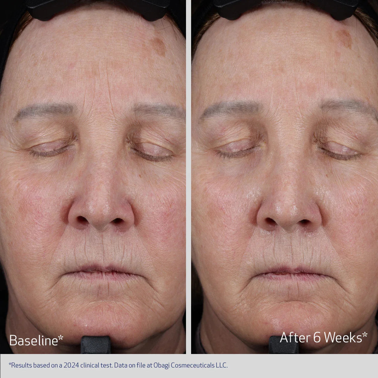 Clinical results showing lifted facial contours and reduced sagging